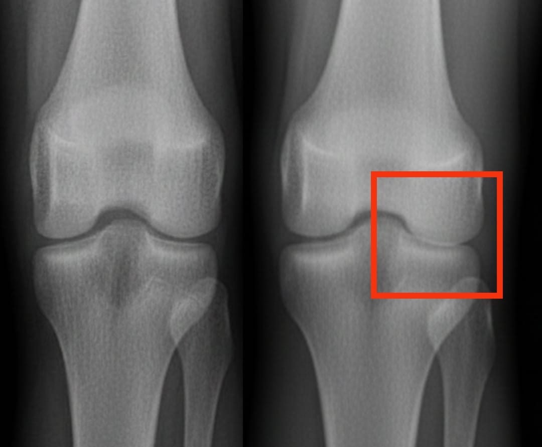 Does platelet-rich plasma relieve knee osteoarthritis better than other injectable treatments?